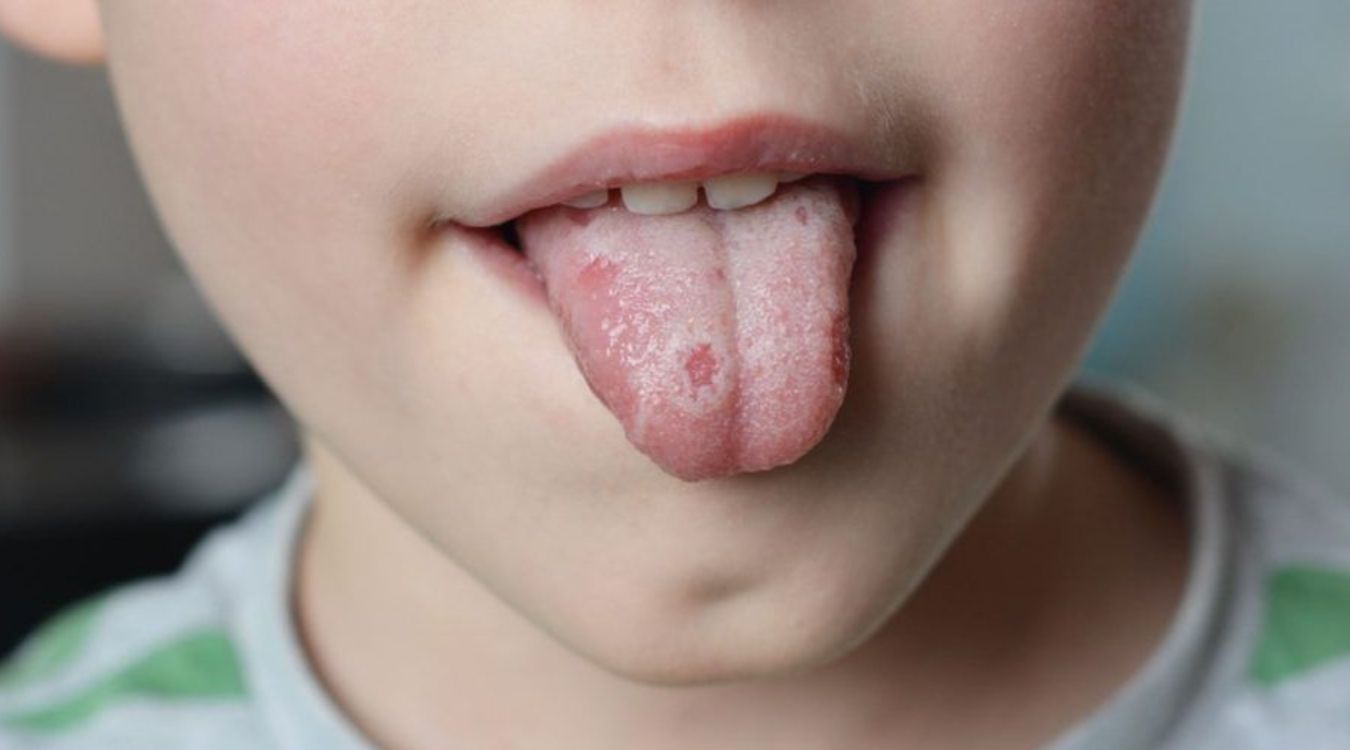 50-facts-about-oral-lichen-planus