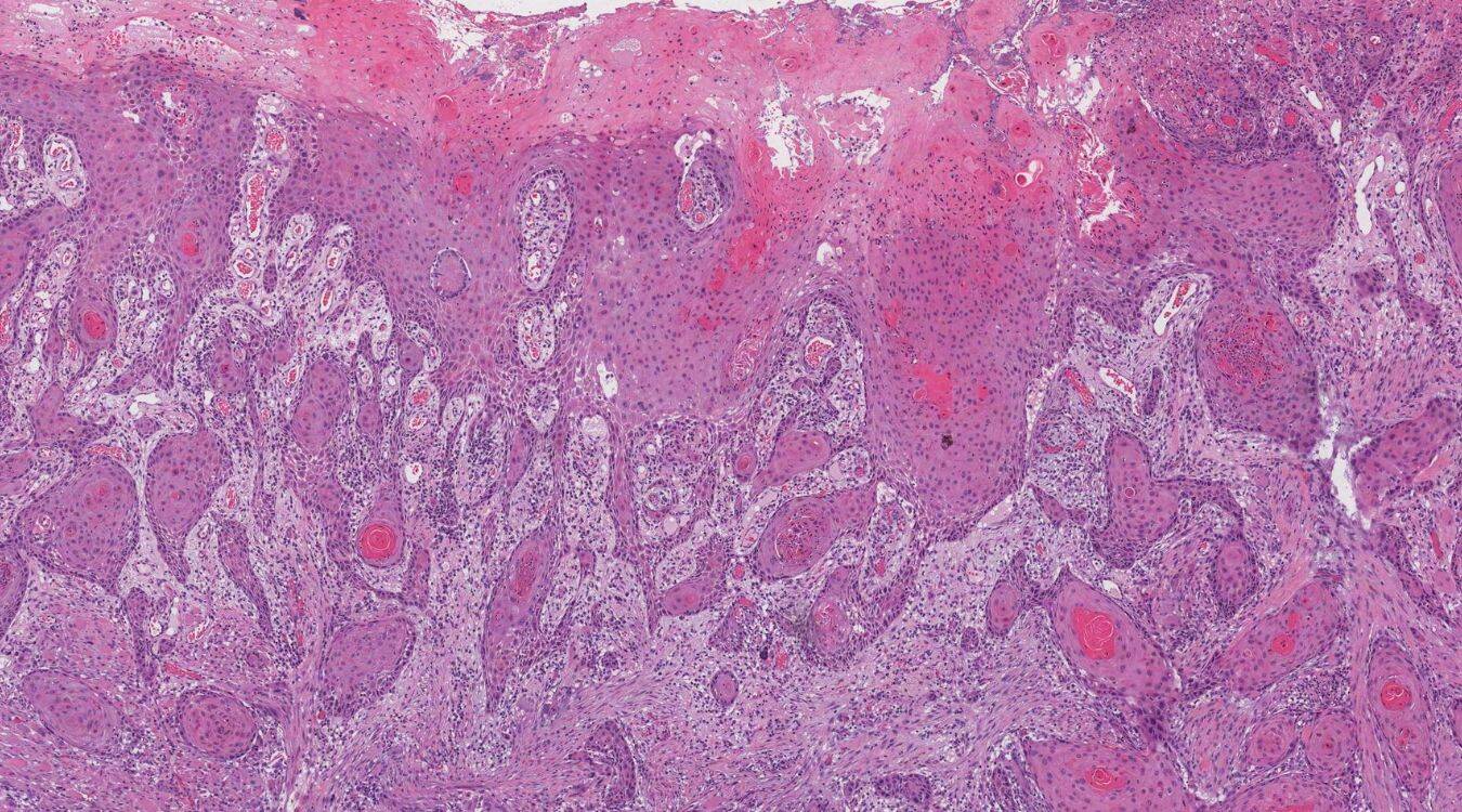 50-facts-about-oral-squamous-cell-carcinoma