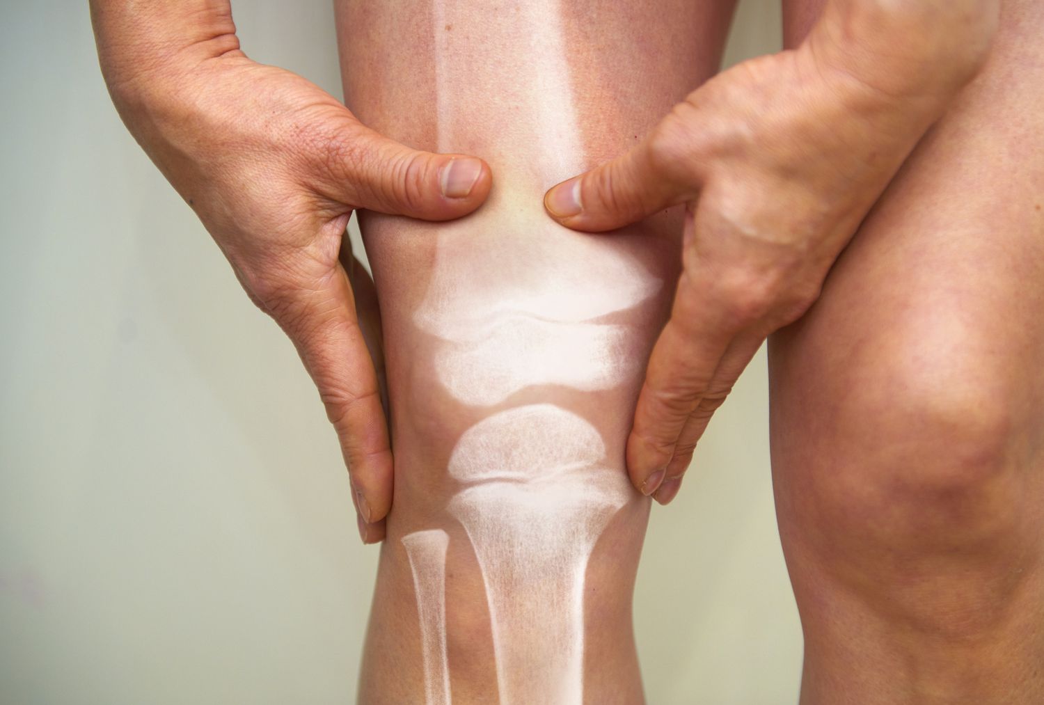 50-facts-about-osteopetrosis