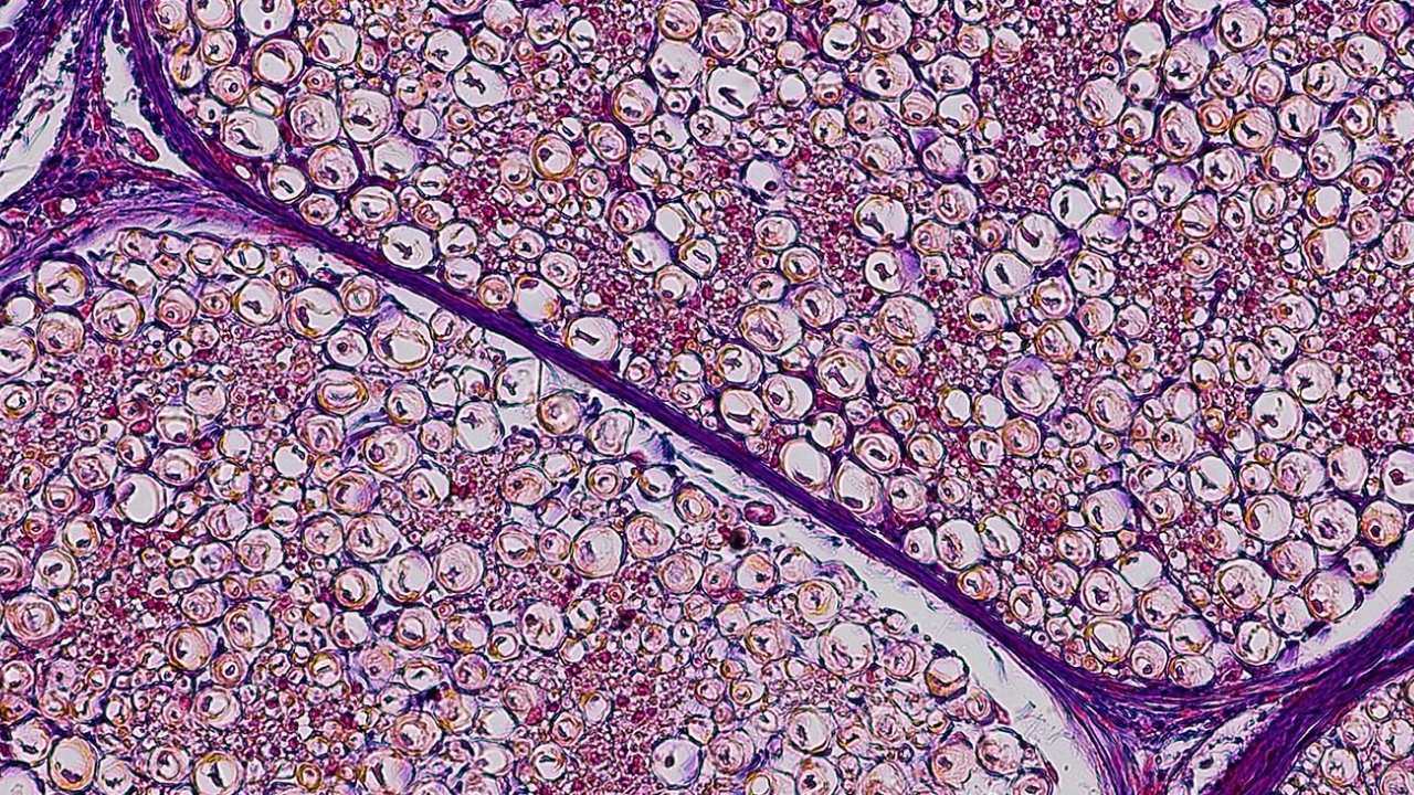 50-facts-about-peripheral-type-neurofibromatosis