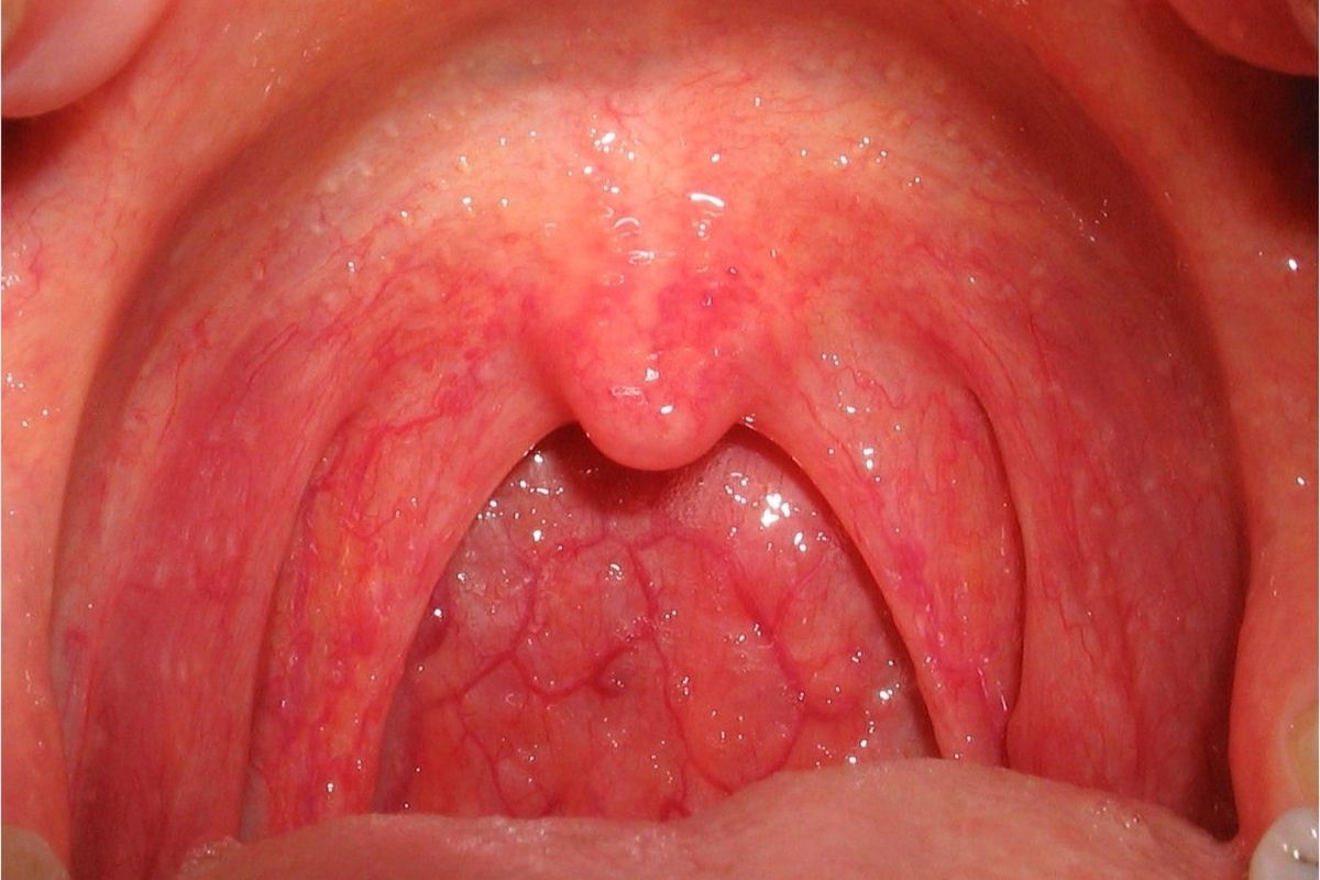 50-facts-about-pharyngitis