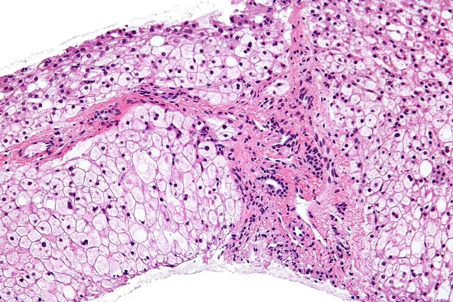 50-facts-about-phosphoglucomutase-deficiency-type-2