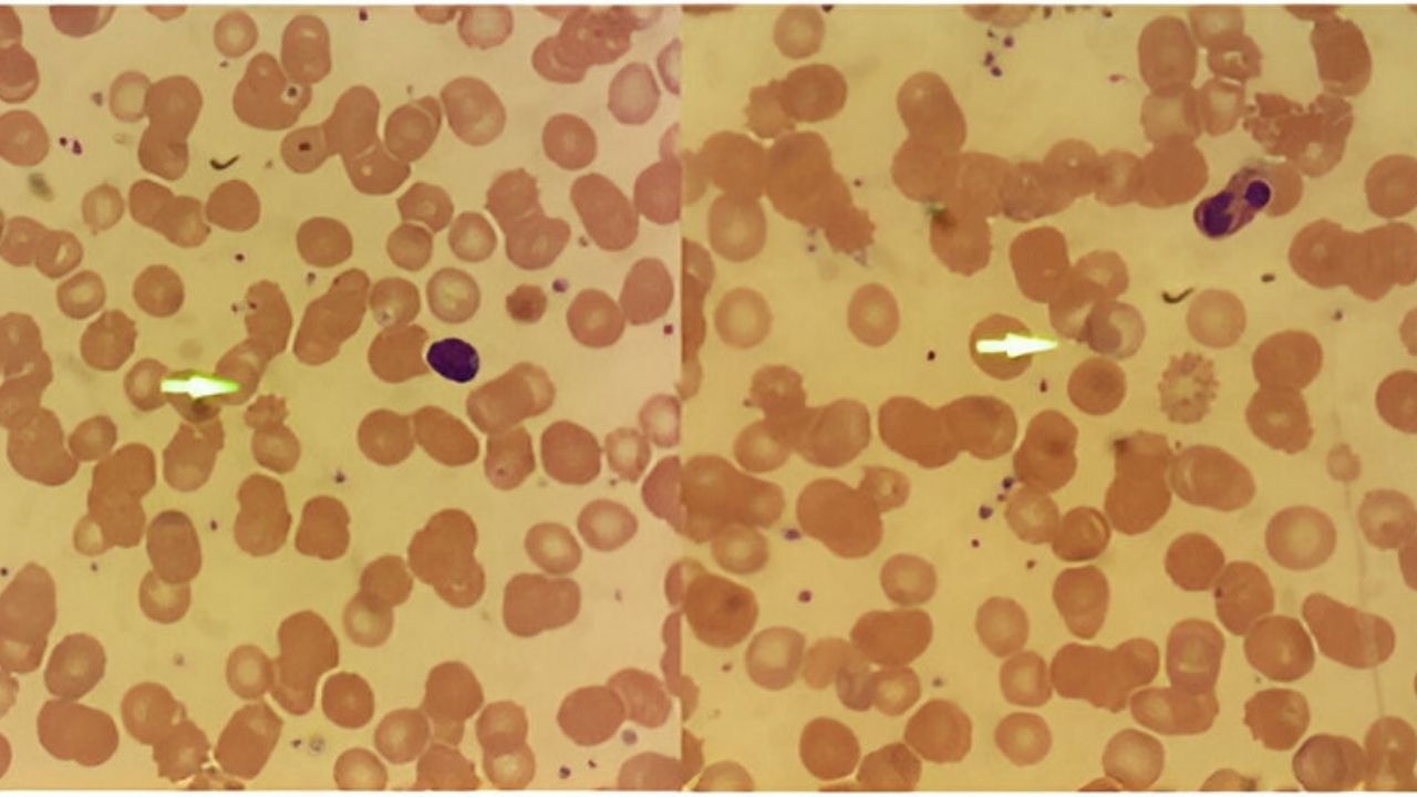 50-facts-about-phosphoglycerate-kinase-1-deficiency