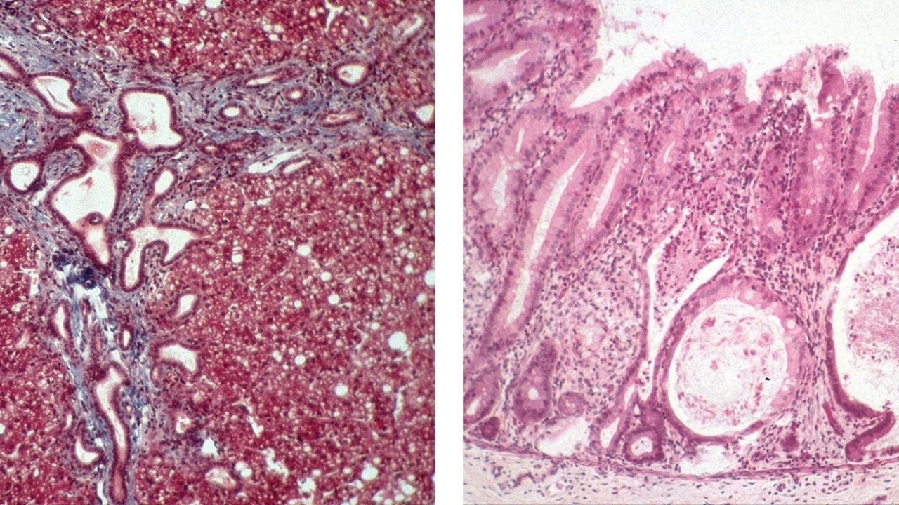 50-facts-about-phosphomannoisomerase-deficiency