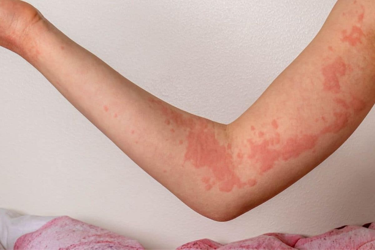 50-facts-about-physical-urticaria