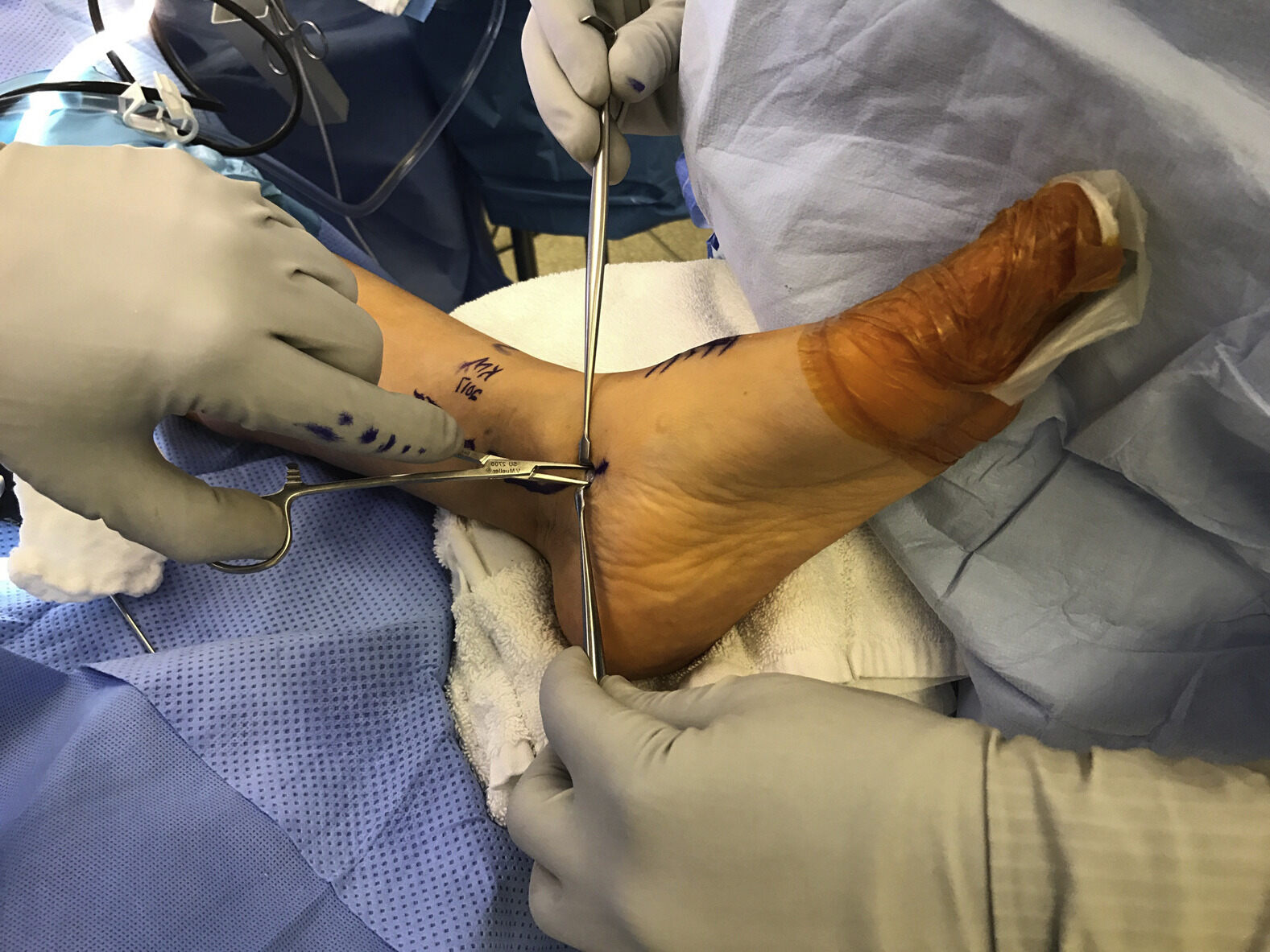 50-facts-about-posterior-tibial-tendon-rupture