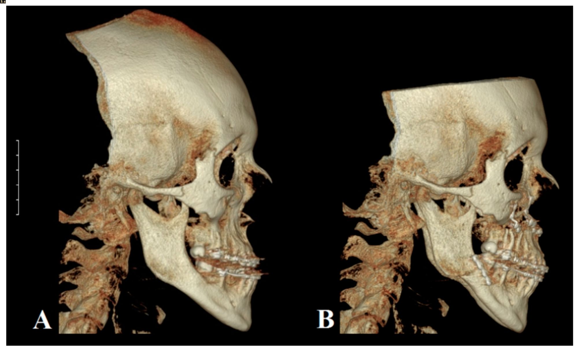 50-facts-about-prognathism-dominant