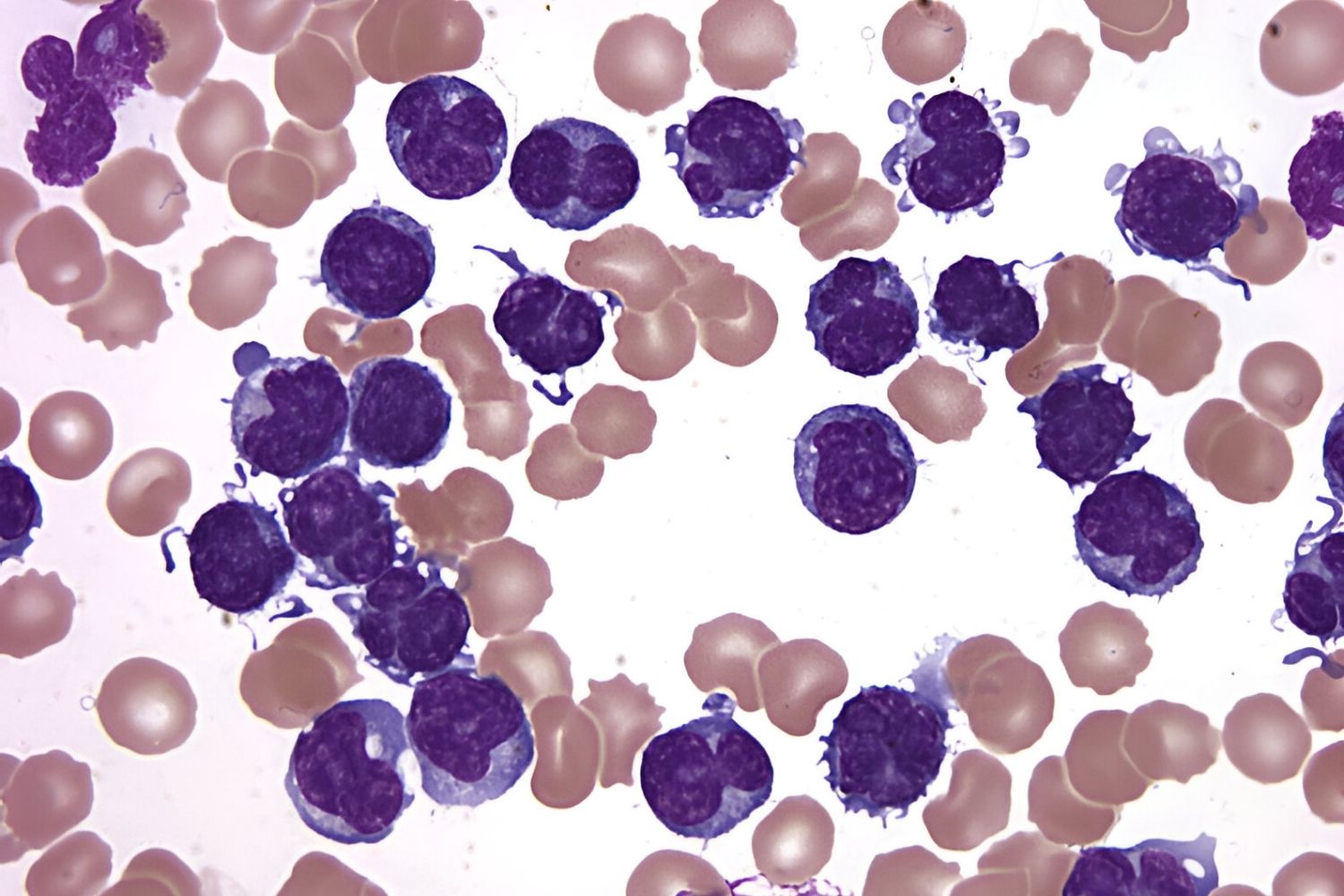 50-facts-about-prolymphocytic-leukemia