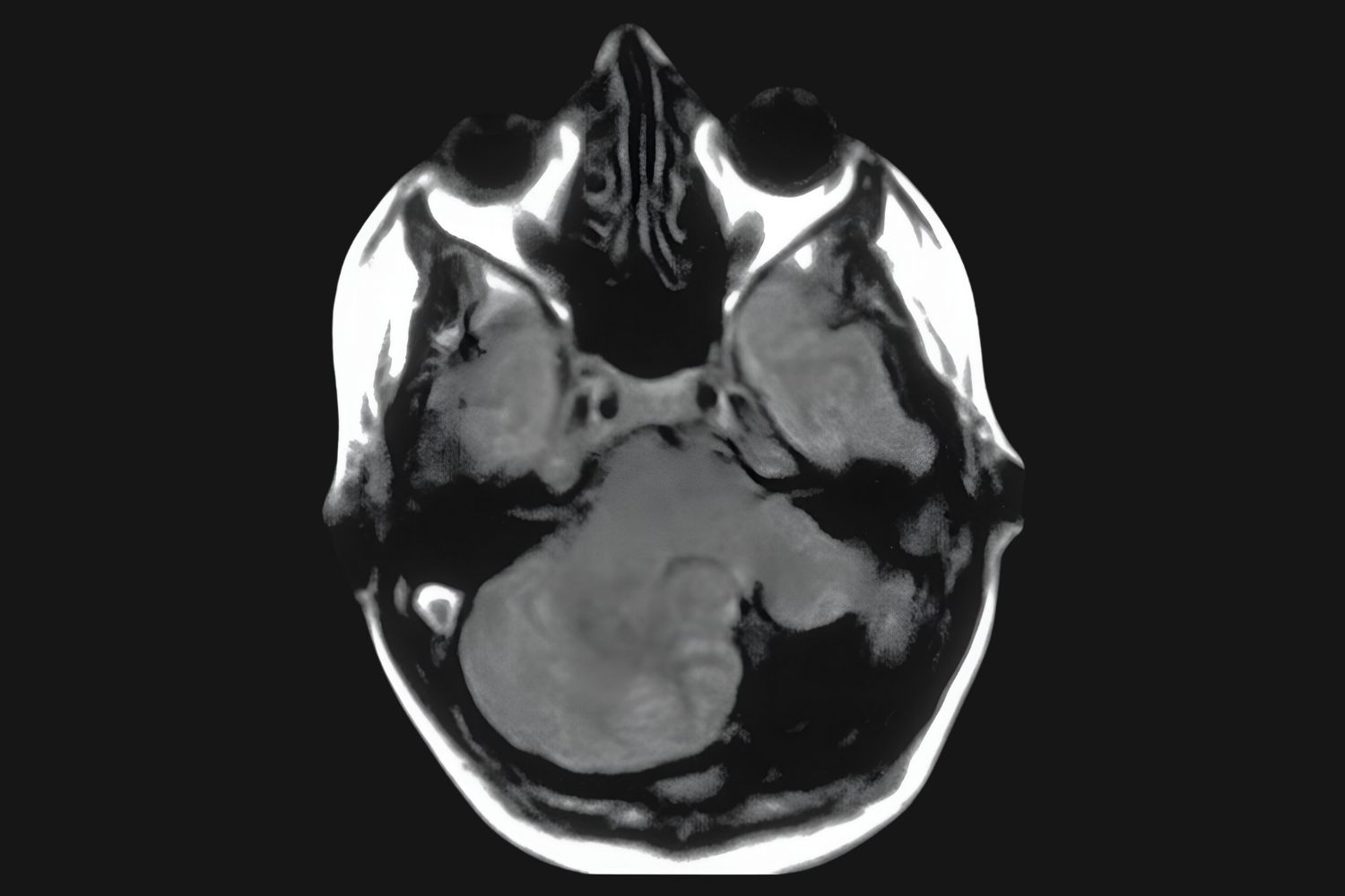 50-facts-about-prosencephaly-cerebellar-dysgenesis