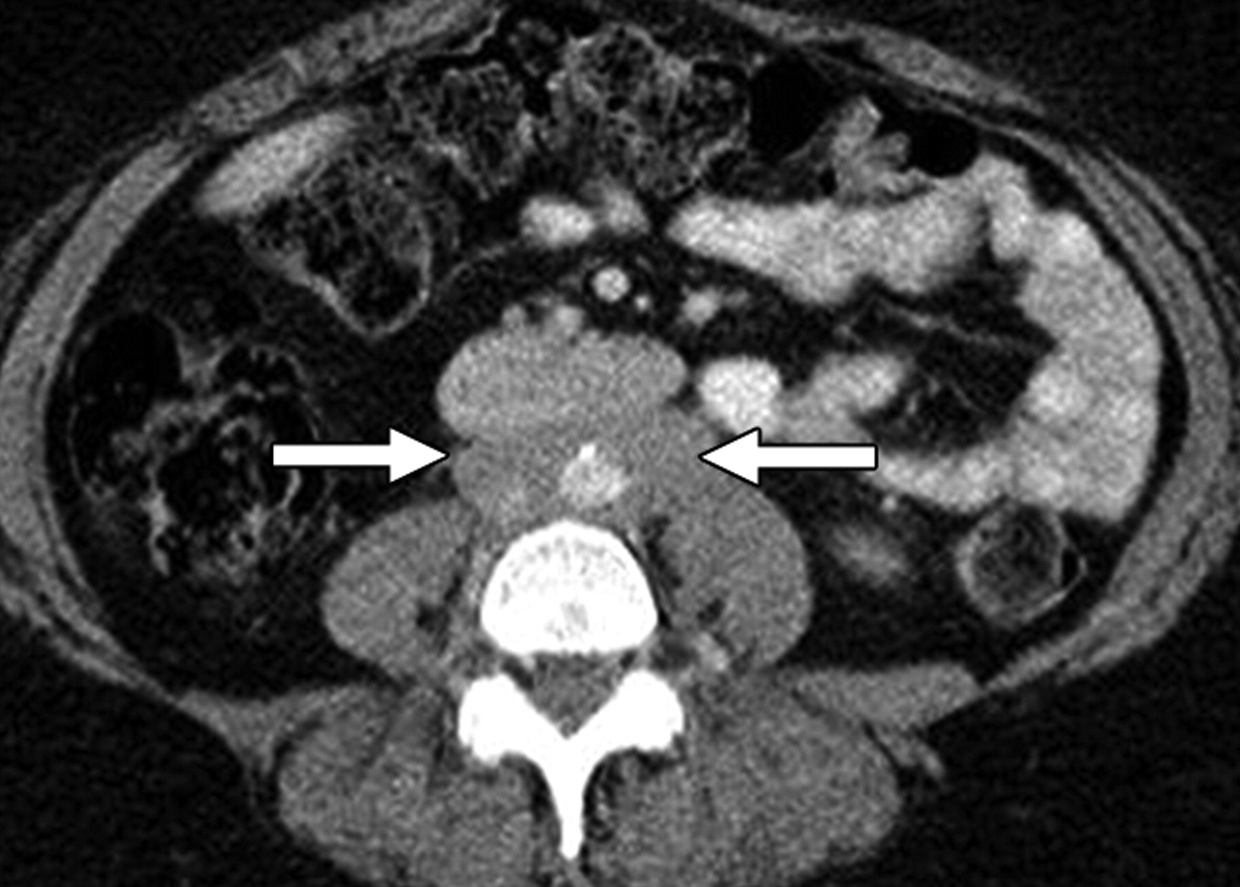 50-facts-about-retroperitoneal-fibrosis