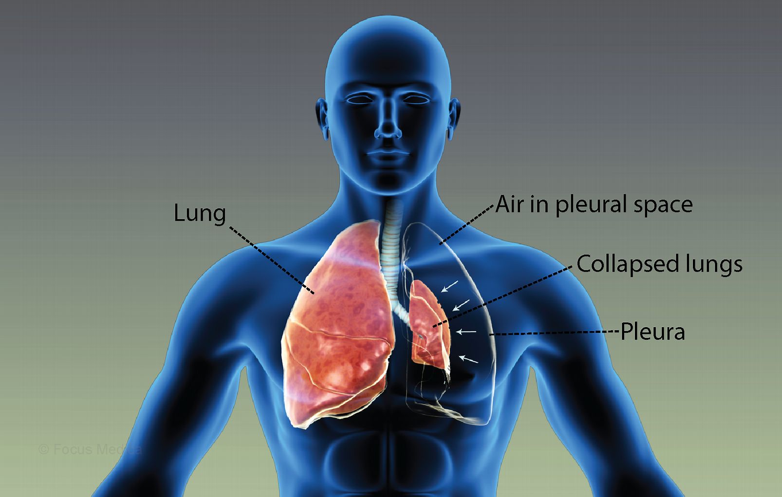 50-facts-about-spontaneous-pneumothorax-familial-type