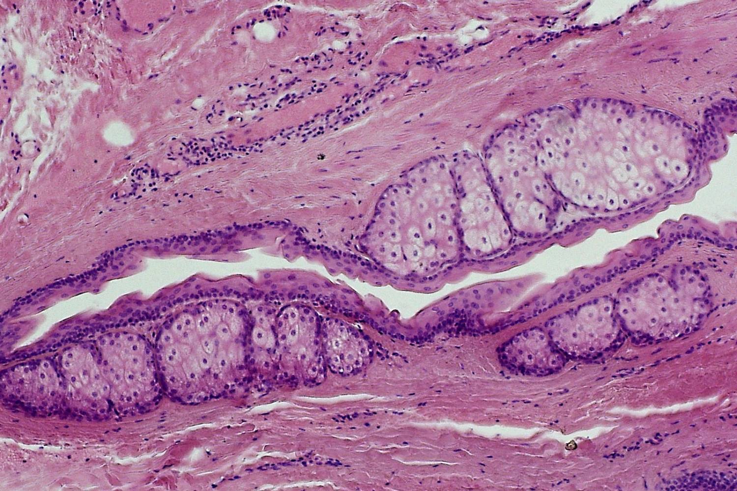 50-facts-about-steatocystoma-multiplex