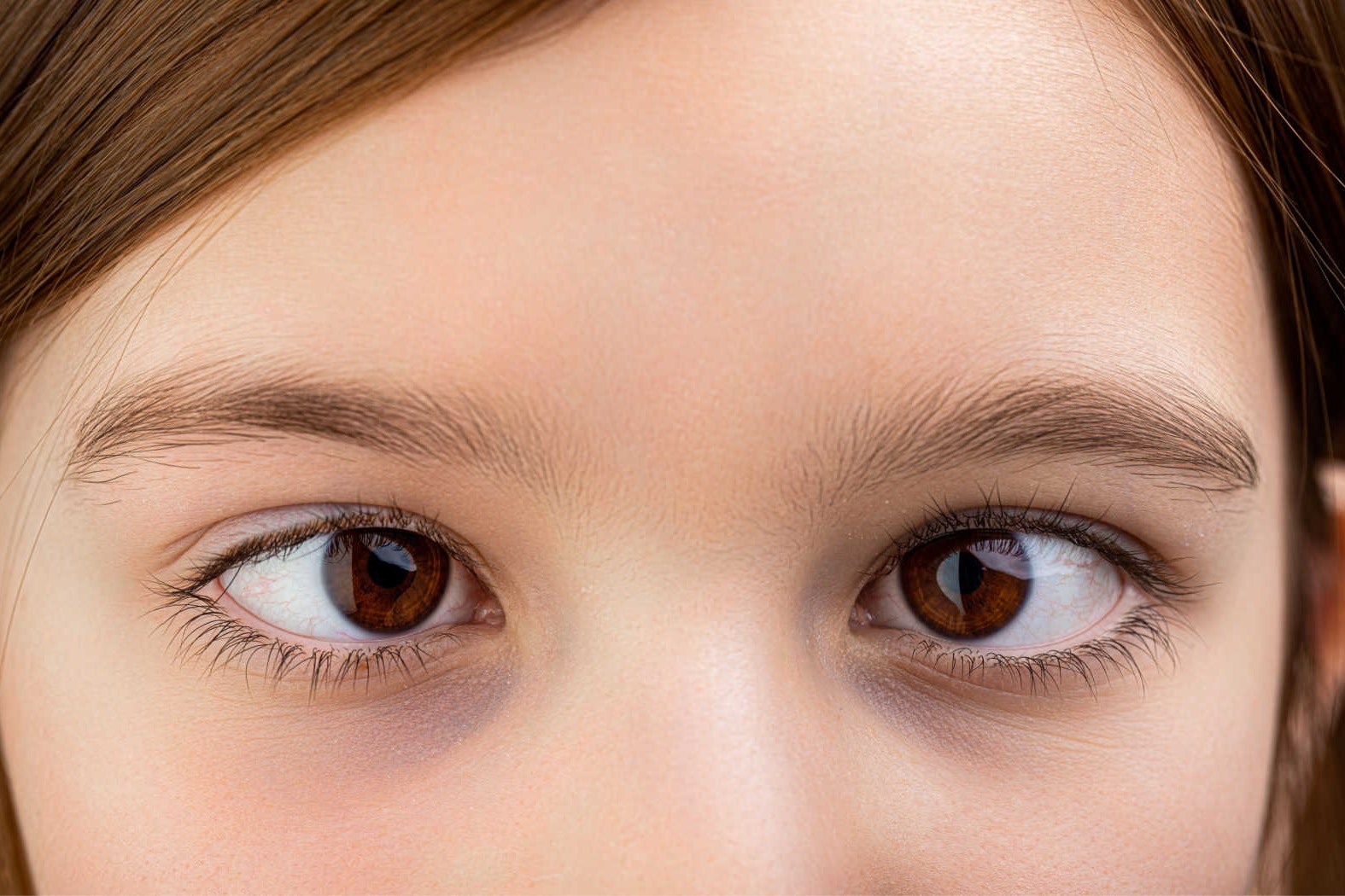 50-facts-about-strabismus