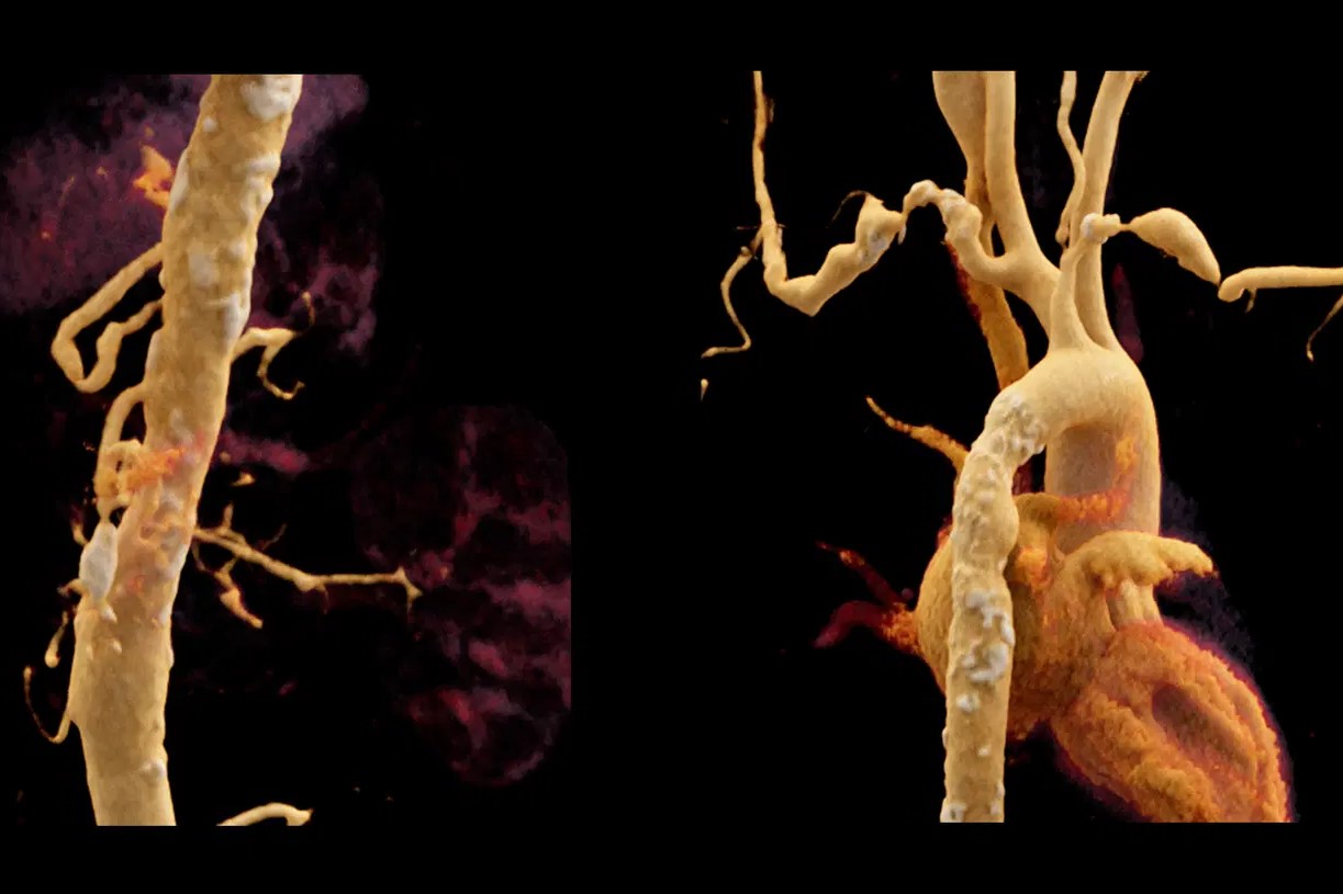 50-facts-about-takayasu-arteritis