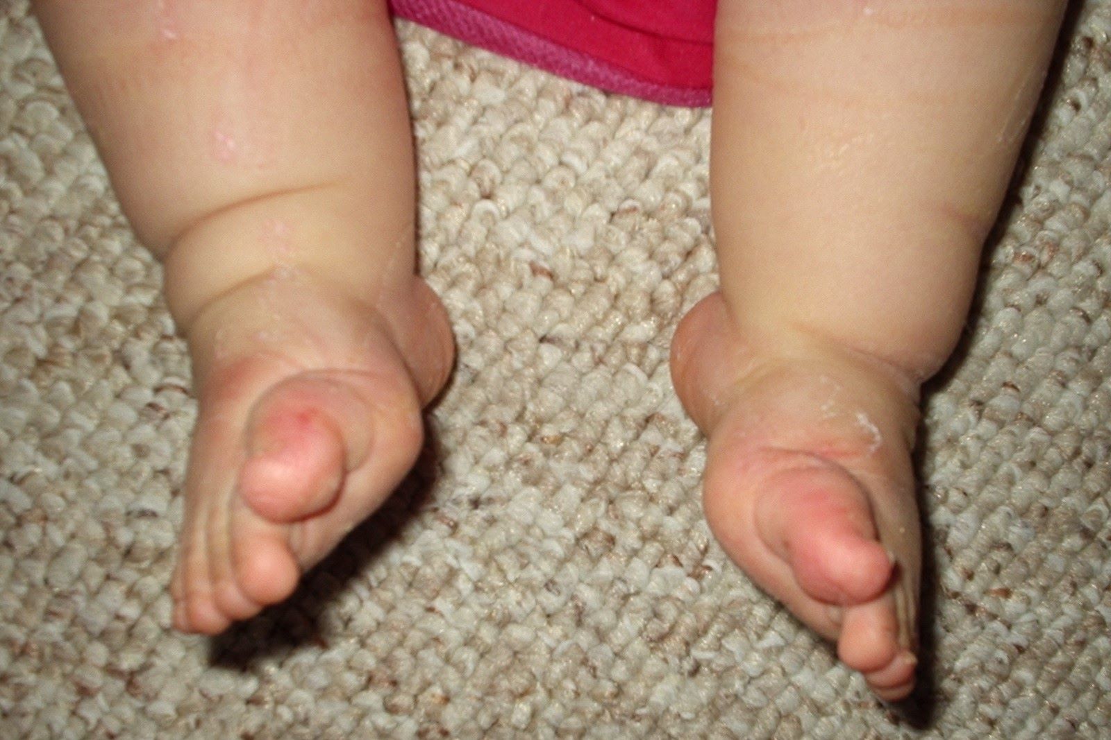 50-facts-about-talipes-equinovarus