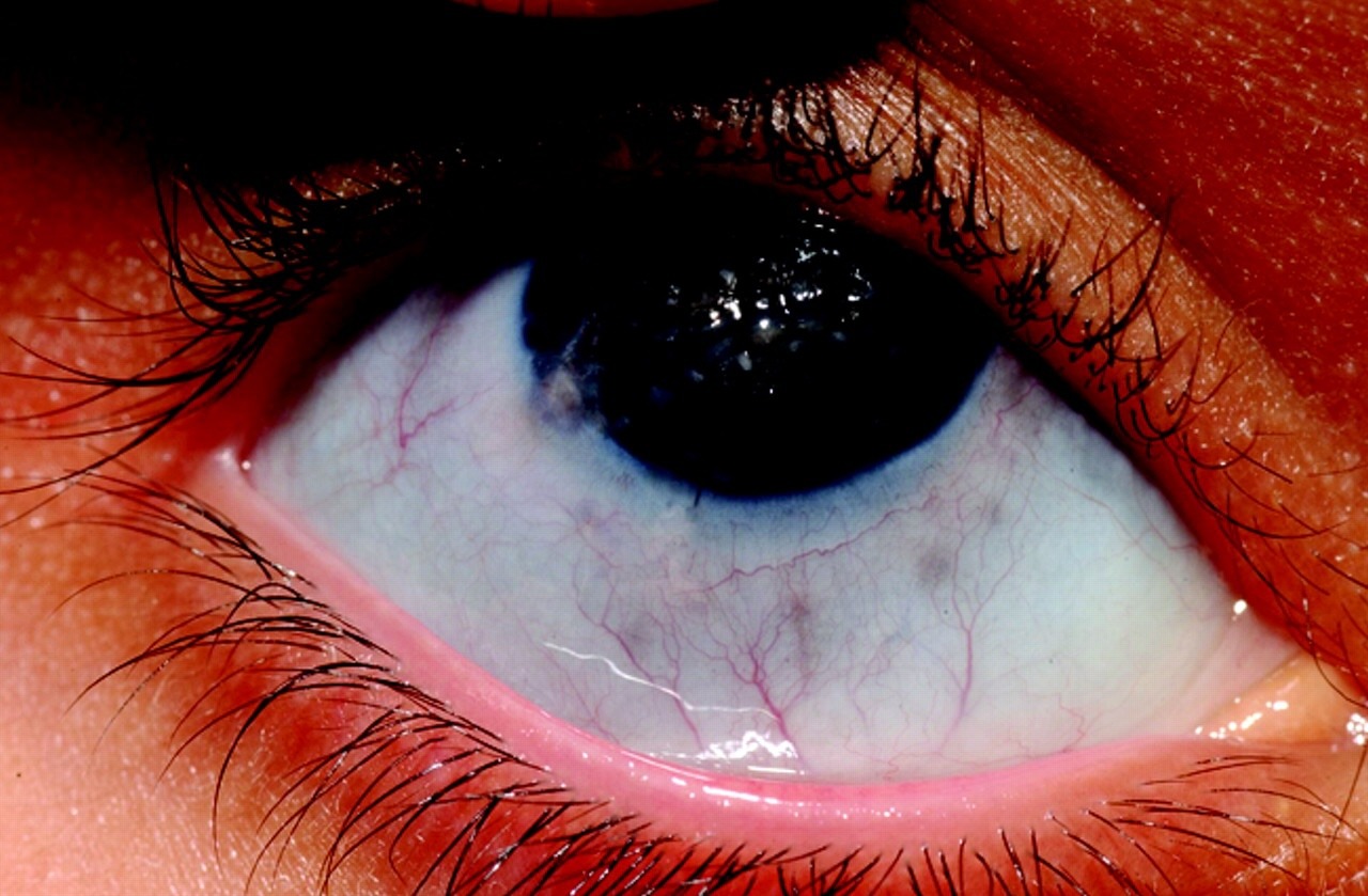 25-facts-about-brittle-cornea-syndrome-bcs-eds