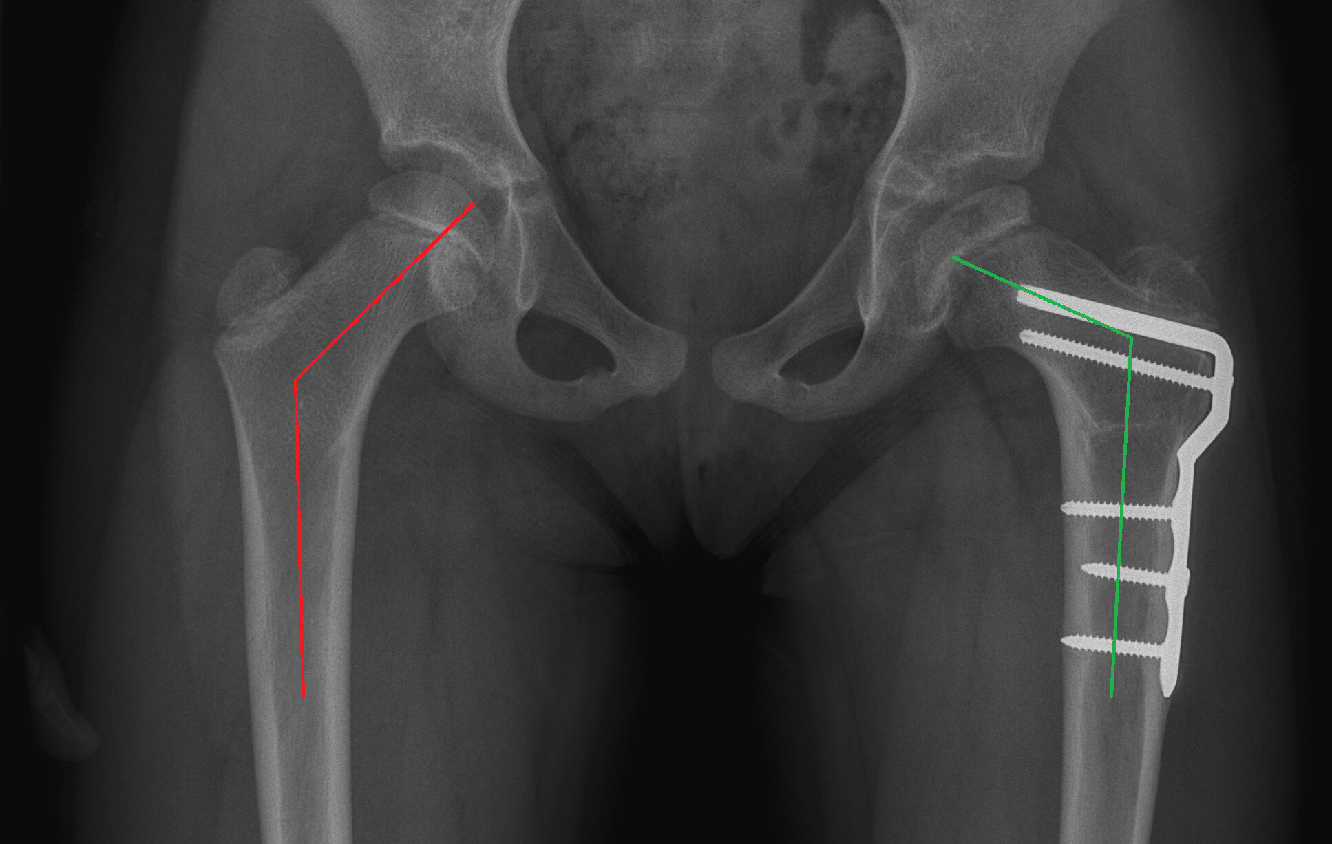 25-facts-about-calve-disease