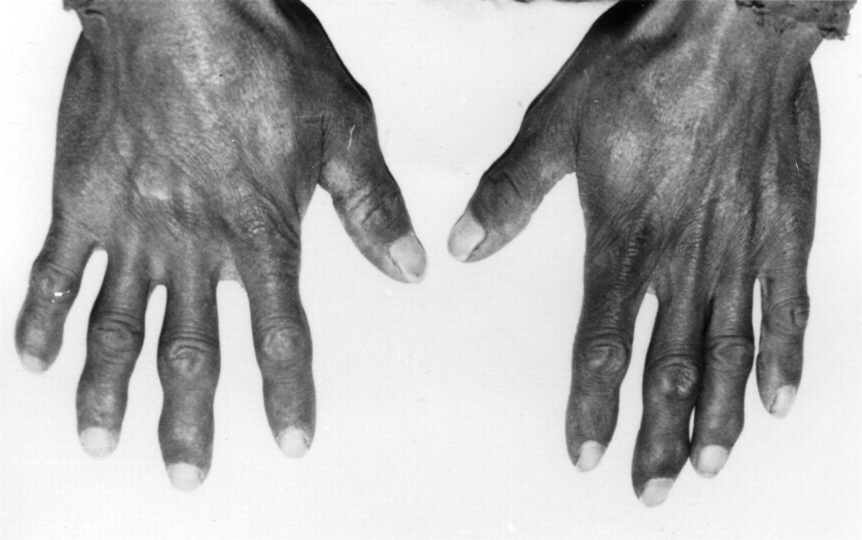 25-facts-about-kashin-beck-disease