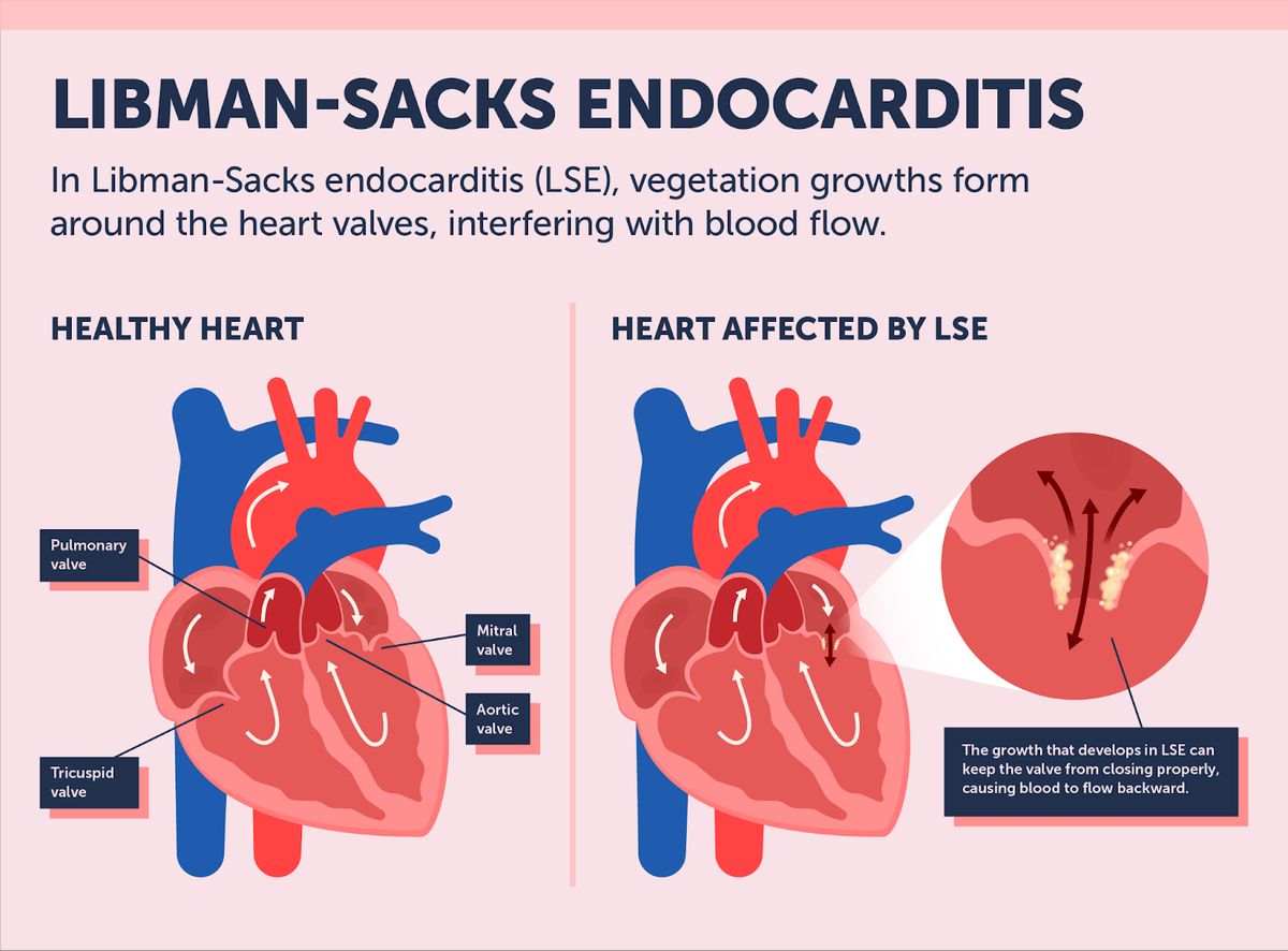 25-facts-about-libman-sacks-disease