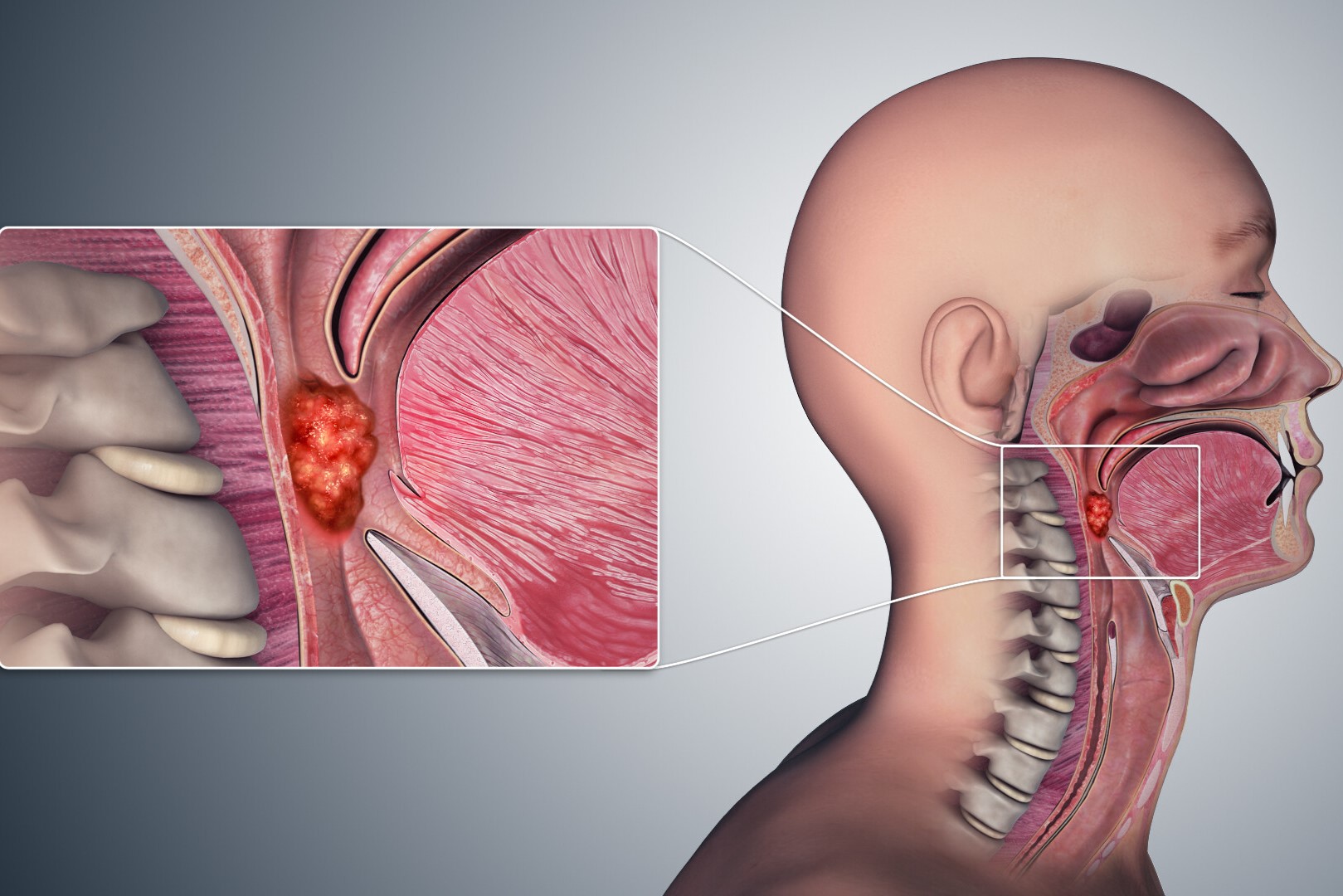 25-facts-about-recurrent-laryngeal-papillomas