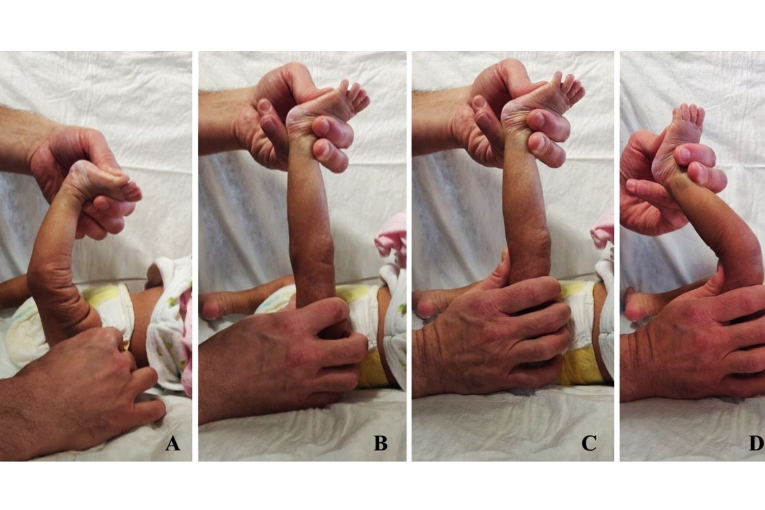 25-facts-about-reductional-transverse-limb-defects