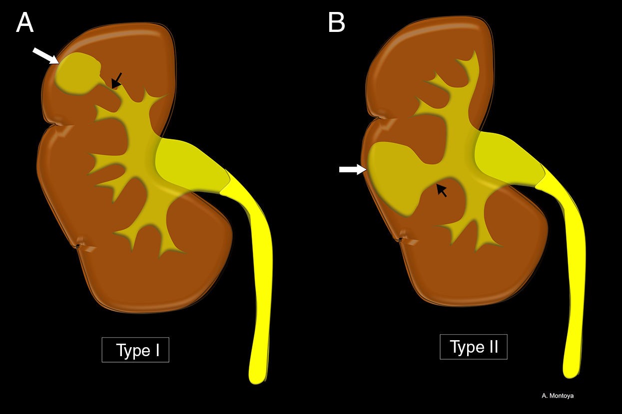 25-facts-about-renal-caliceal-diverticuli-deafness