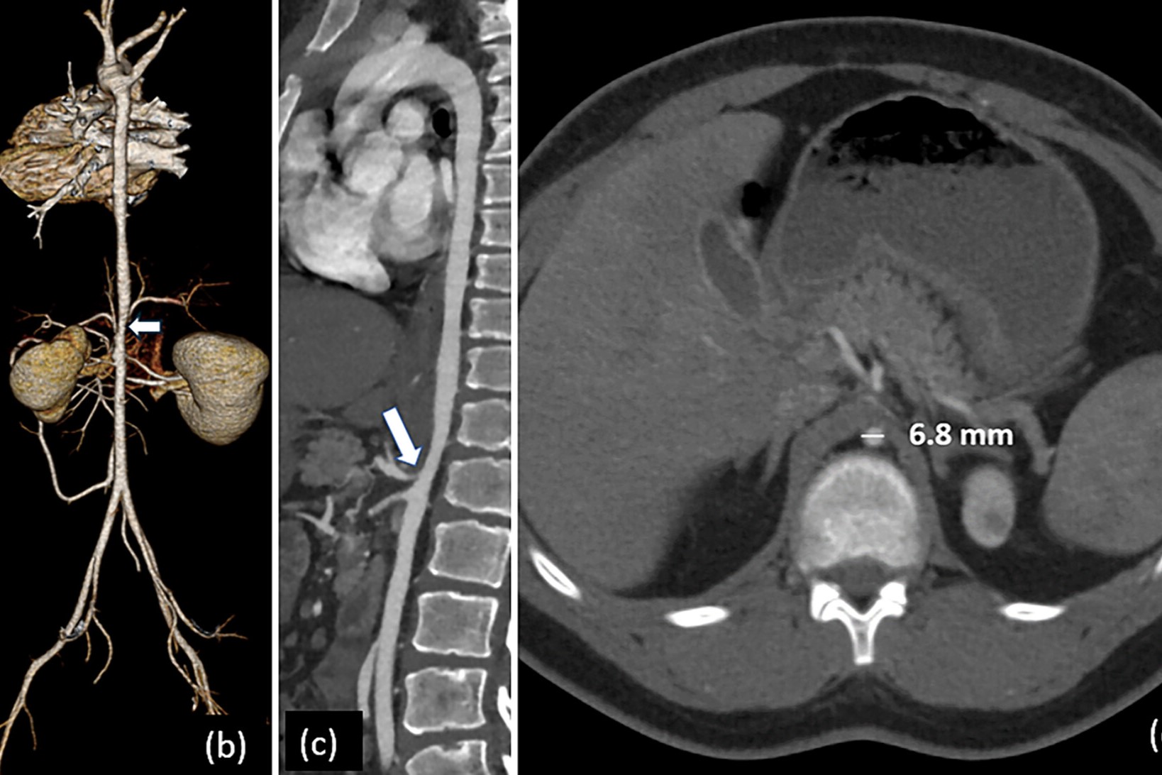 25-facts-about-ruvalcaba-myhre-smith-syndrome