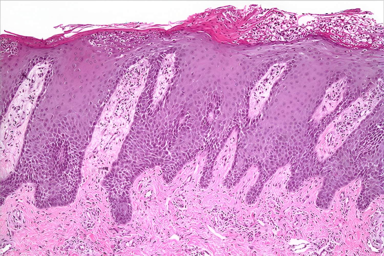 25-facts-about-von-zumbusch-generalized-pustular-psoriasis