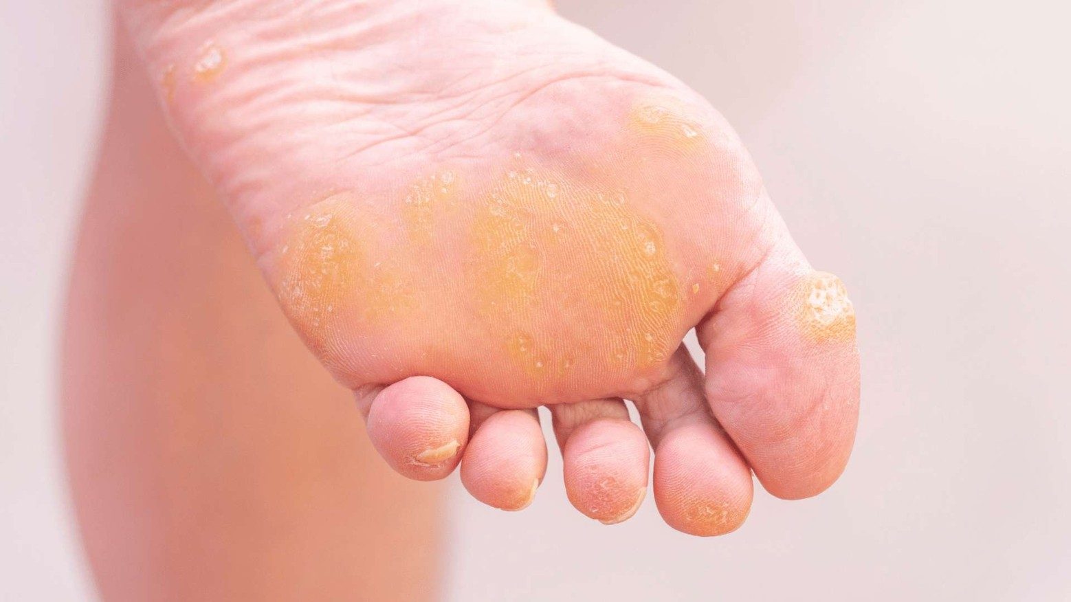 29-facts-about-callus