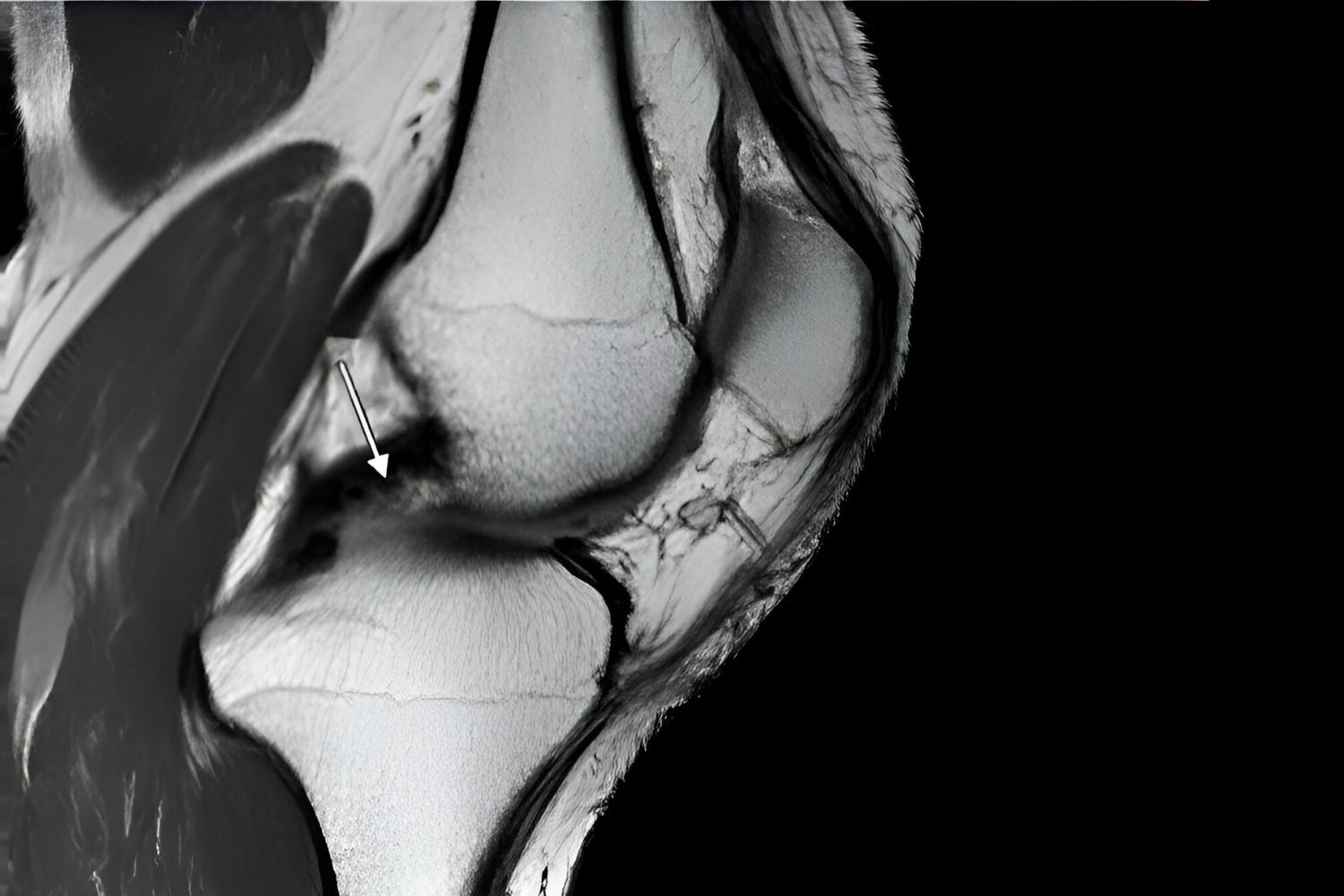 30-facts-about-humphrey-ligament