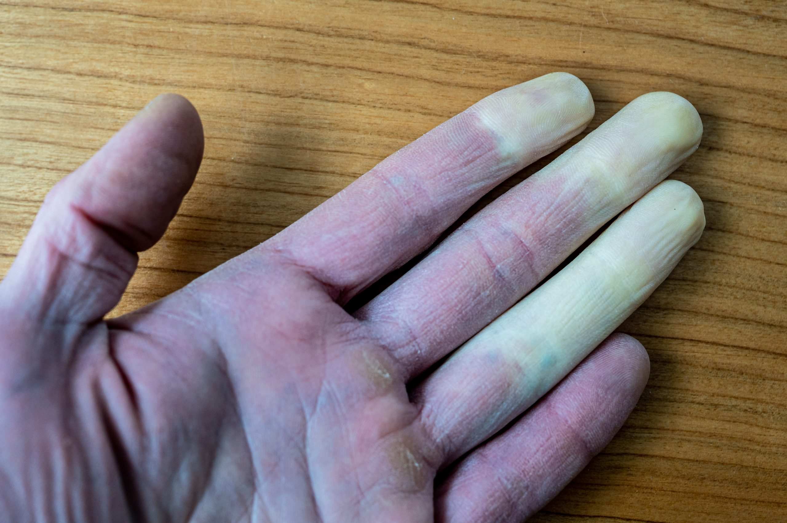 30-facts-about-raynauds-disease-phenomenon