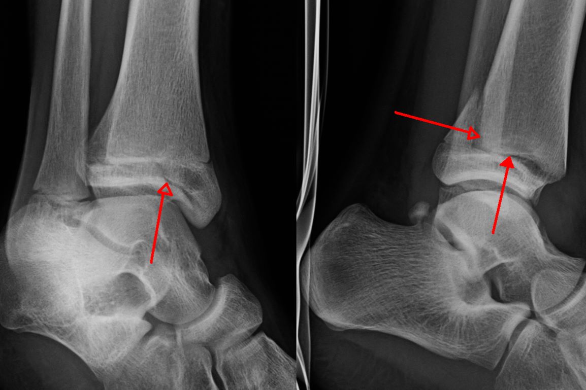 30-facts-about-wagstaffe-le-fort-avulsion-fracture