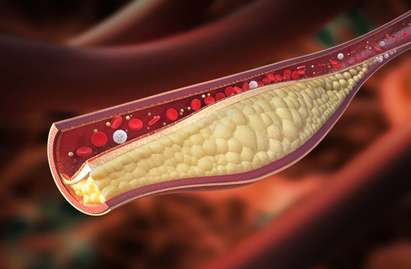 34-facts-about-atherosclerosis