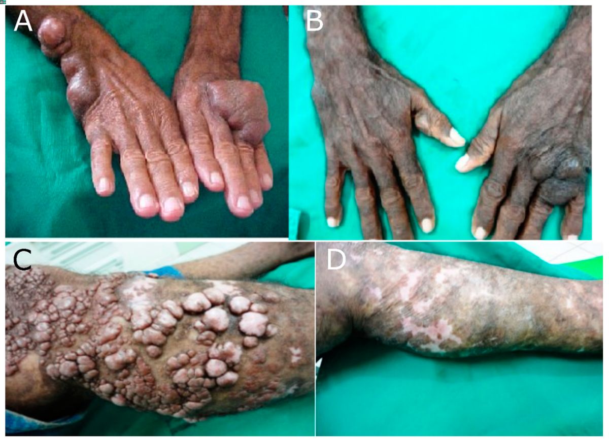 40-facts-about-lobomycosis