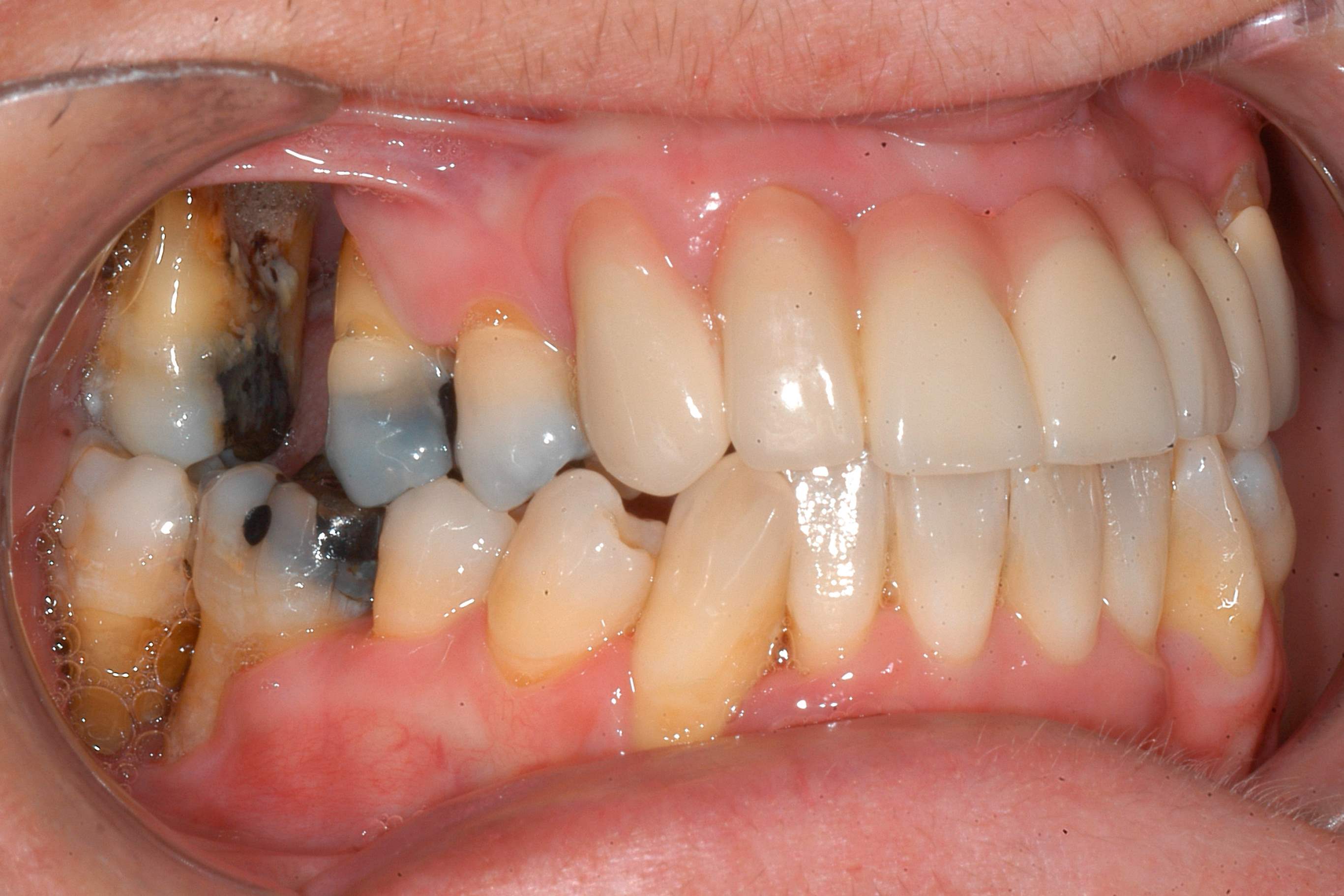 40-facts-about-periodontal-ehlers-danlos-syndrome