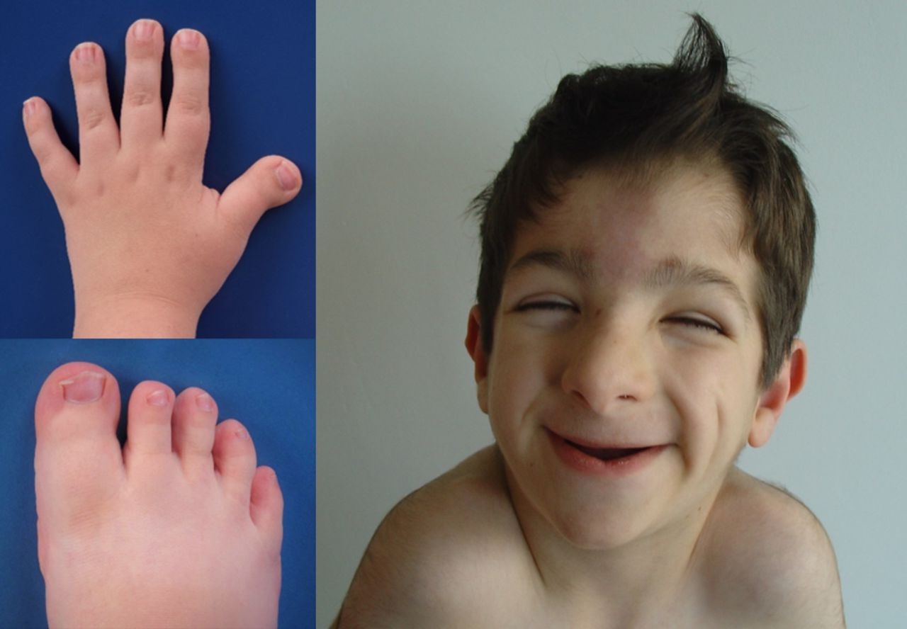 40 Facts About RubinsteinTaybi Syndrome 