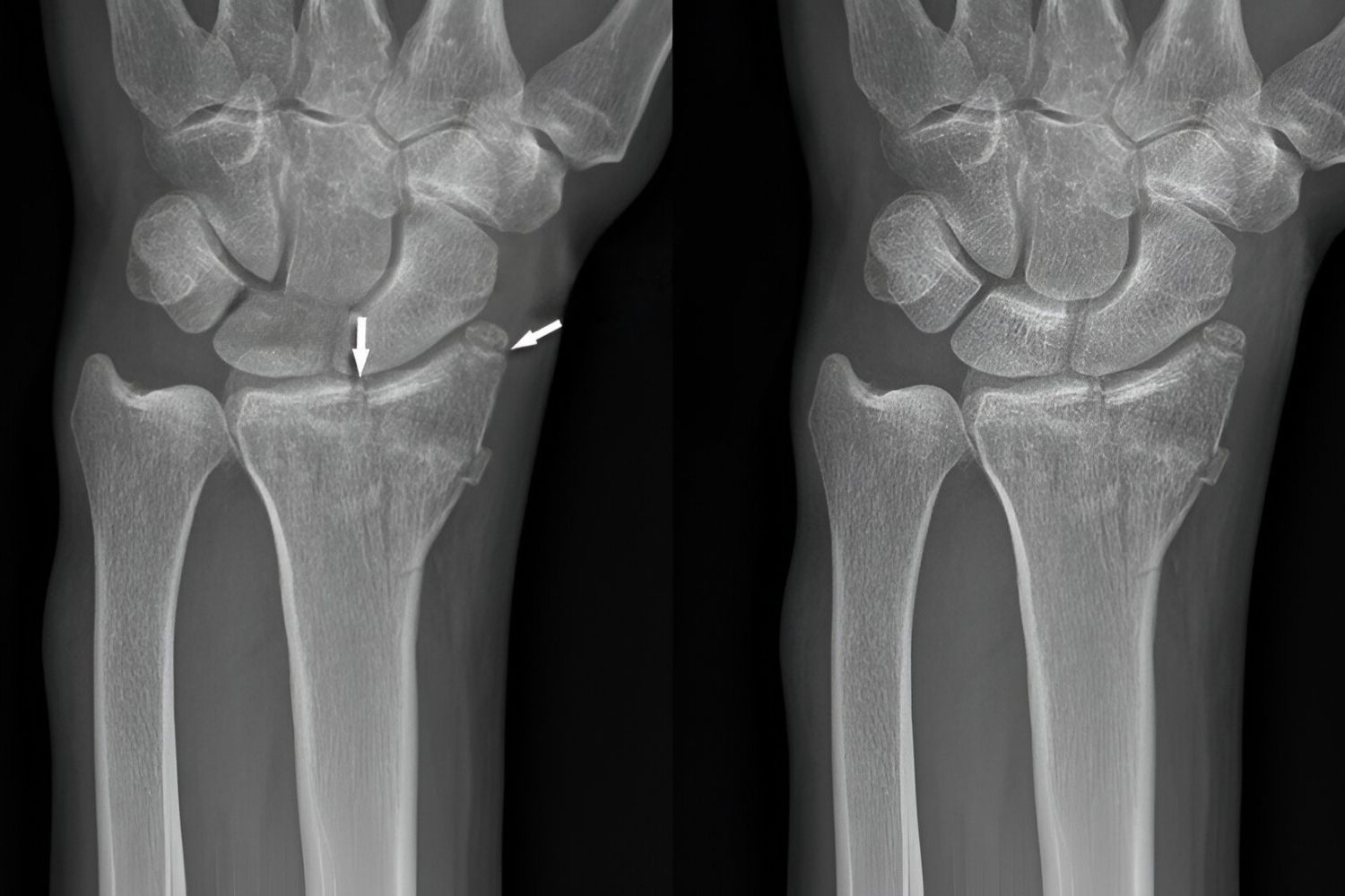 50-facts-about-barton-fracture