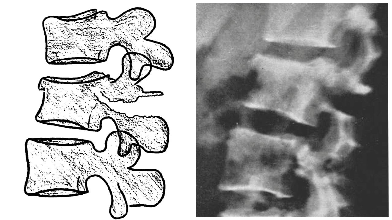 50-facts-about-chance-fracture