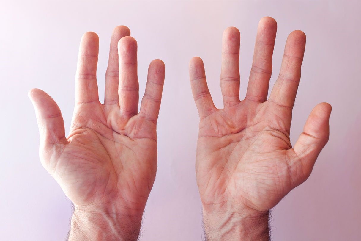 50-facts-about-dupuytren-contracture