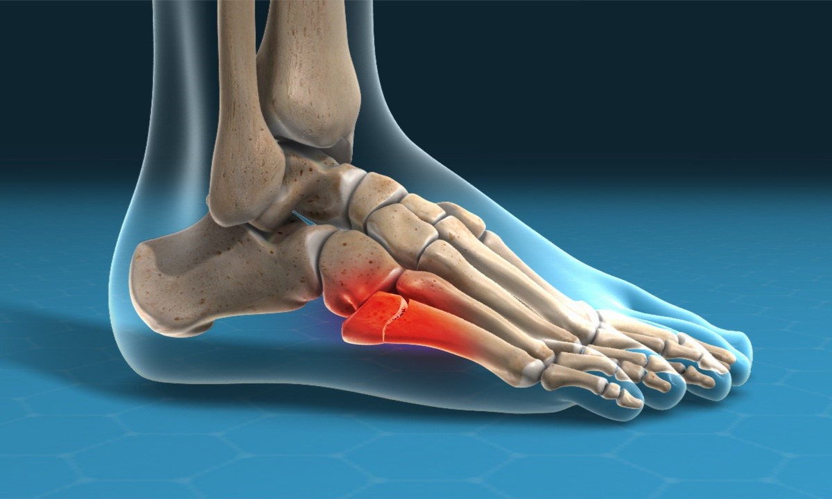 50-facts-about-jones-fracture