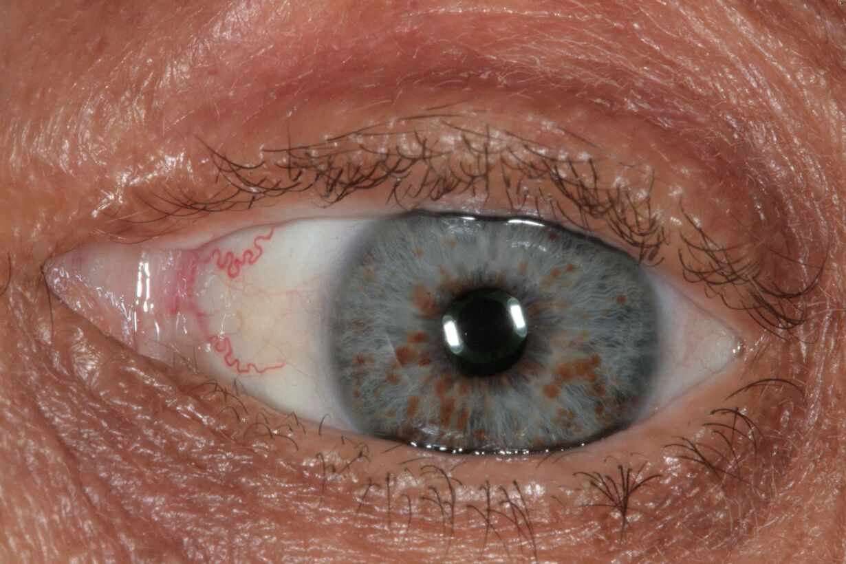 50-facts-about-lisch-nodule