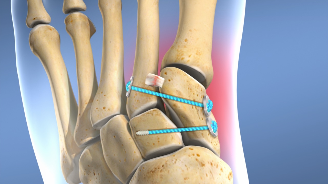 50-facts-about-lisfranc-ligament