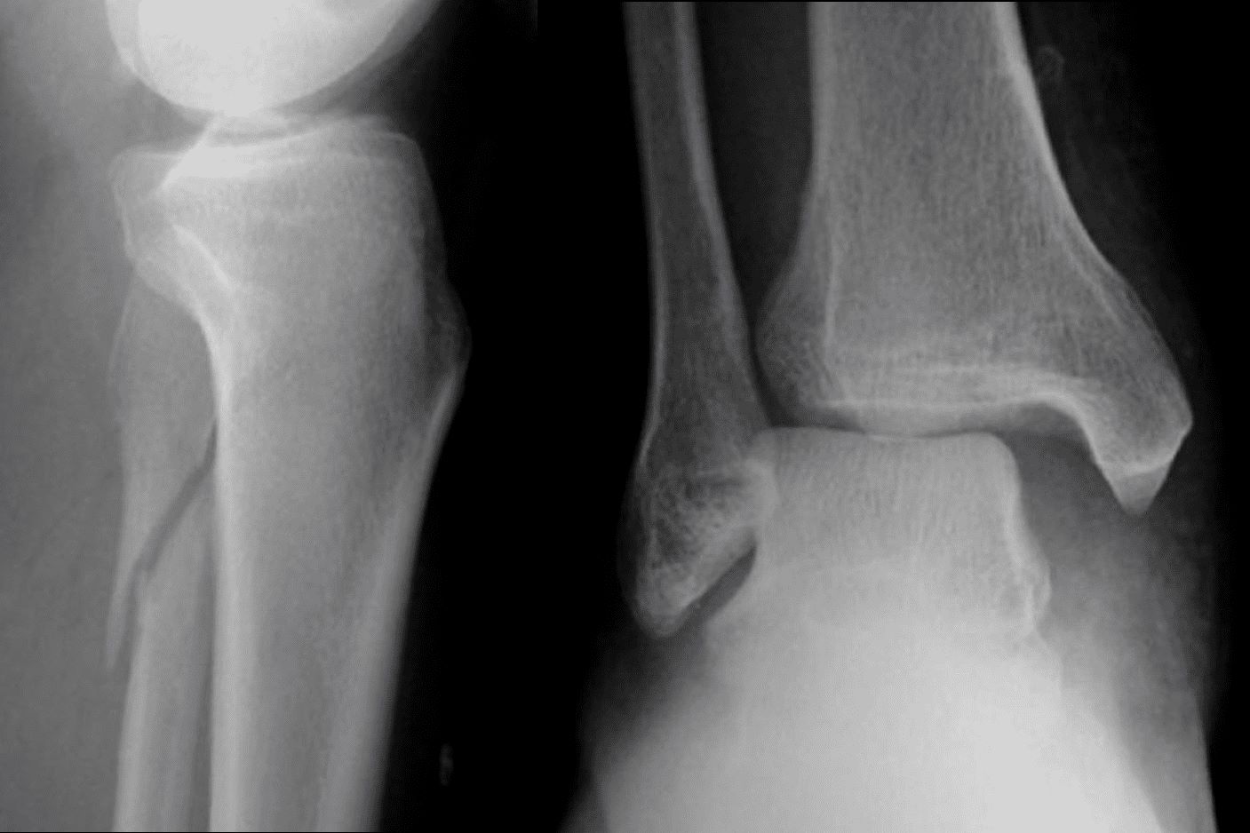 50-facts-about-maisonneuve-fracture