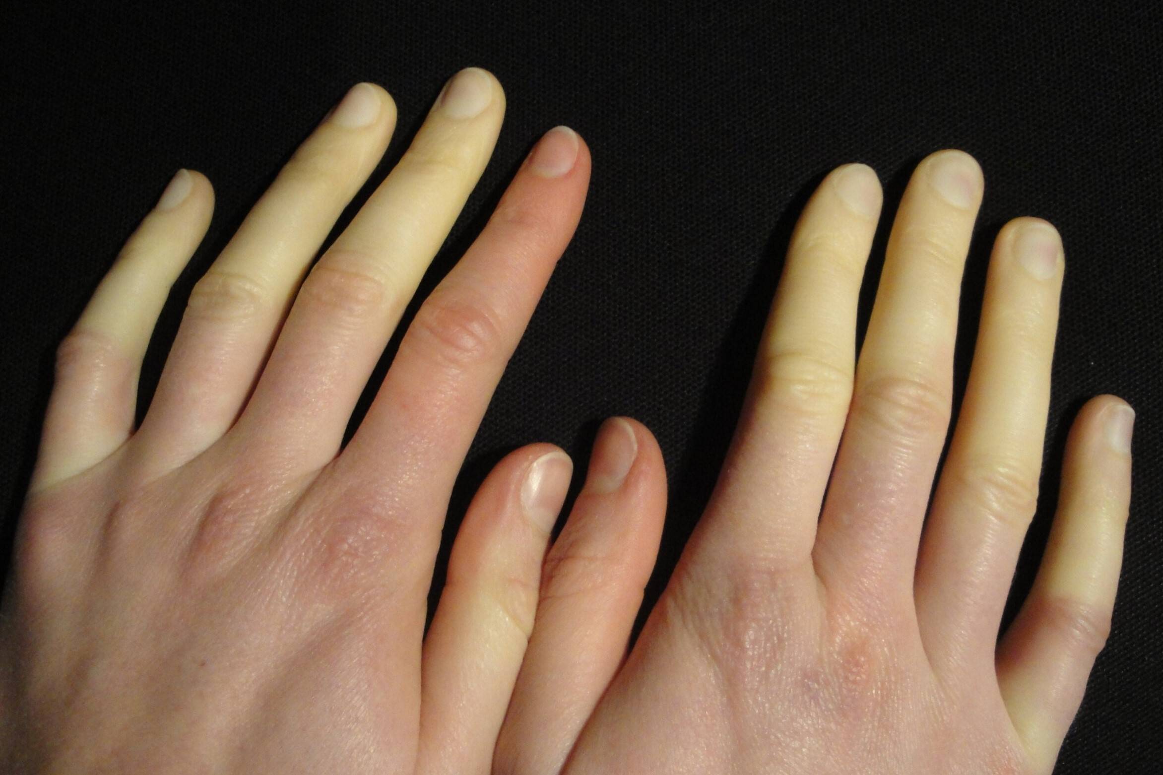 50-facts-about-raynaud-disease