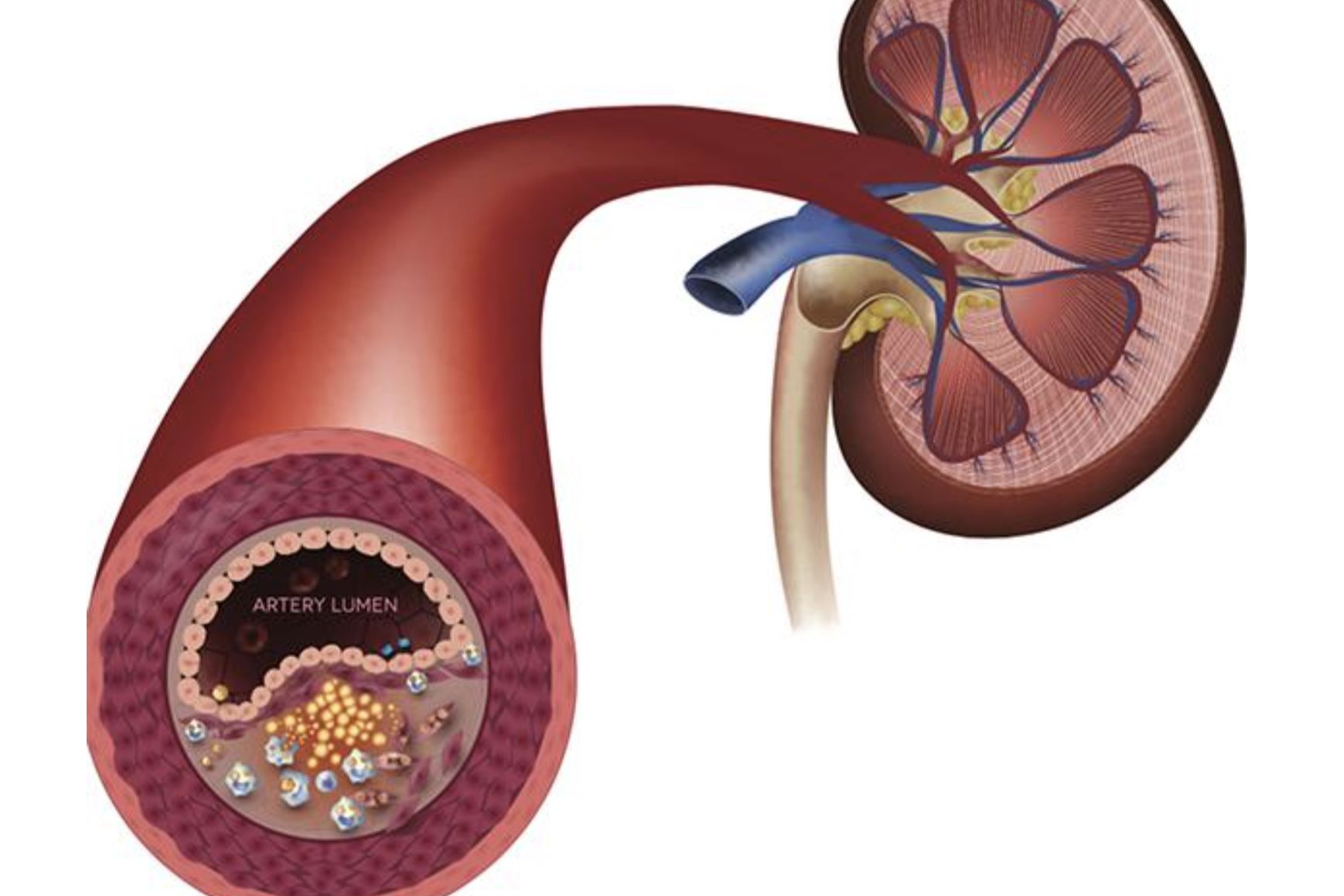 50-facts-about-renal-artery-stenosis