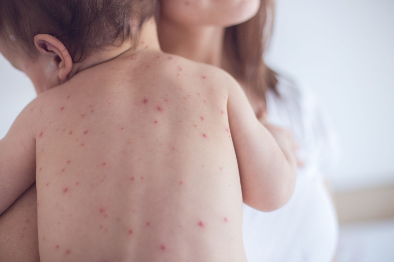 25-important-facts-everyone-should-know-about-measles