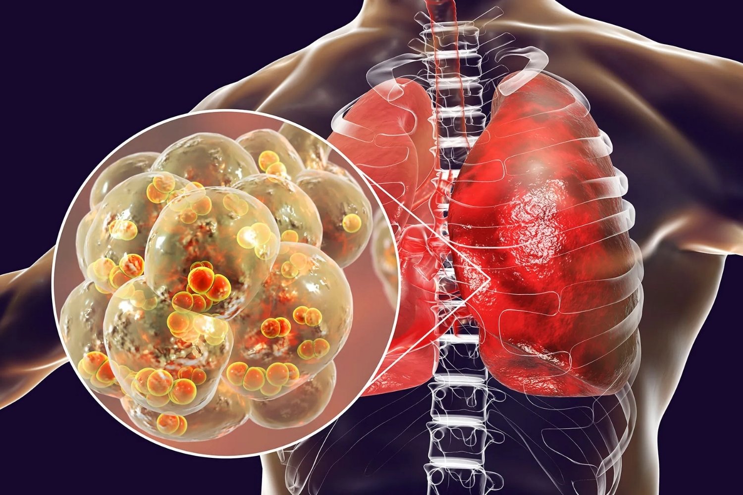 30-facts-about-pneumonia