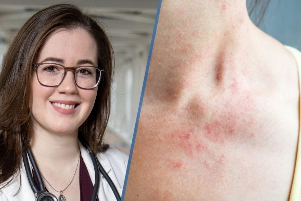 25 Facts About AlphaGal Syndrome 