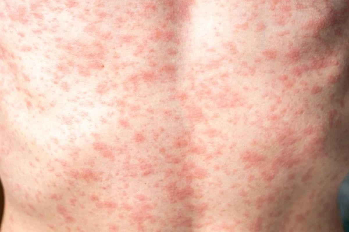 25 Facts About The Measles Outbreak In South Carolina 